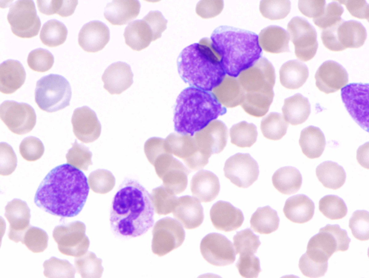 A. Peripheral blood smear (WBC 40.49K/µL) with 76% blasts, intermediate in size with high nuclear:cytoplasmic ratios, slightly irregular nuclear contours, small nucleoli and agranular cytoplasm.  Normocytic anemia with anisocytosis and slight polychromasia is present (H&E, 1000x oil).